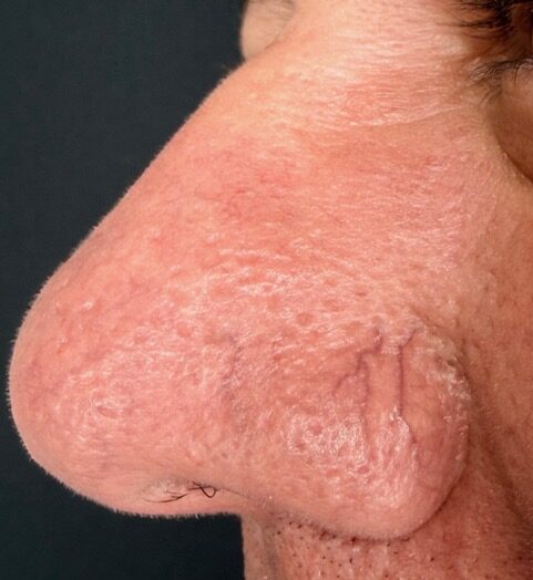 Facial Vein Removal after treatment