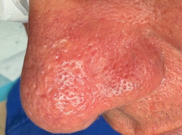 Facial Vein Removal before treatment