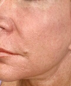 Exosomes Rejuvenation after treatment