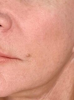 Exosomes Rejuvenation before treatment