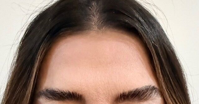 Forehead Lines after treatment