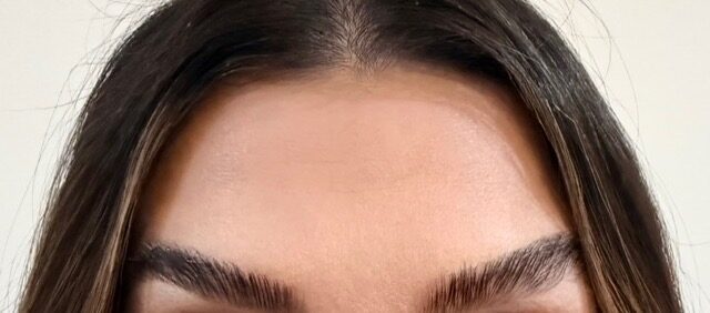 Frown Lines after treatment