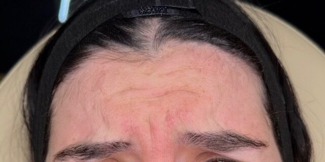 Forehead Lines before treatment