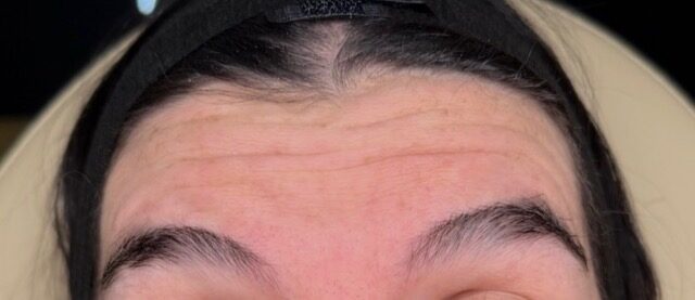 Frown Lines before treatment
