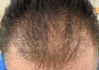Scalp Treatment before treatment