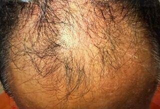 Scalp Treatment after treatment