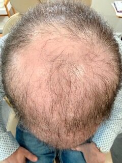 Hair Restoration after treatment