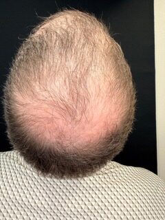 Hair Restoration before treatment